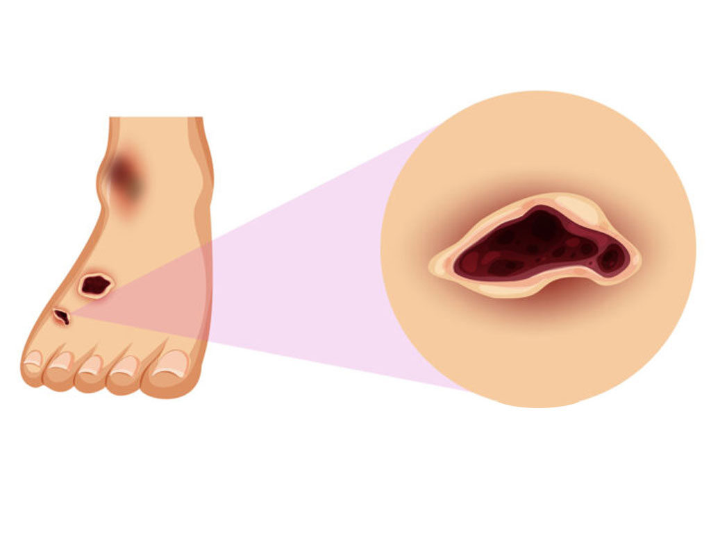 Arterial Wounds Unlocking The Secrets To Effective Treatment And Recovery