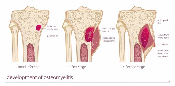 Osteomyelitis A How to Guide to Management and Treatment