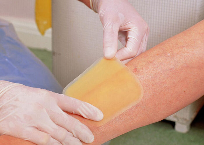 Innovative Solutions: How Hydrocolloid Dressings Enhance Wound Care