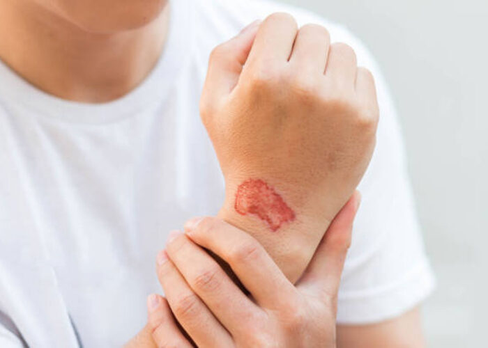 Wound Complications Uncovered: A Guide to Recognizing Warning Signs
