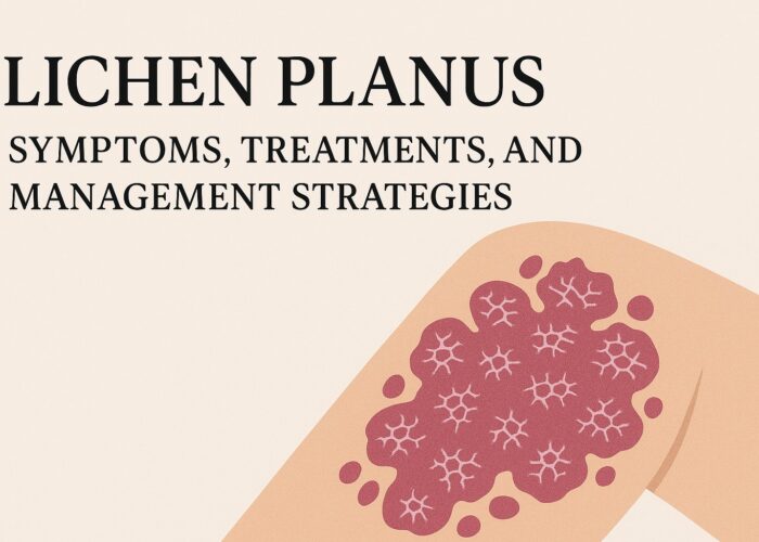 Lichen Planus: Symptoms, Treatments, and Management Strategies